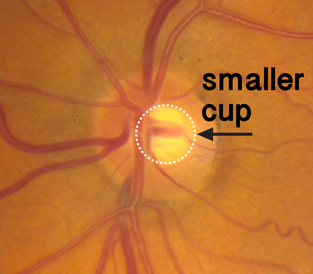 glaucomatous optic nerve